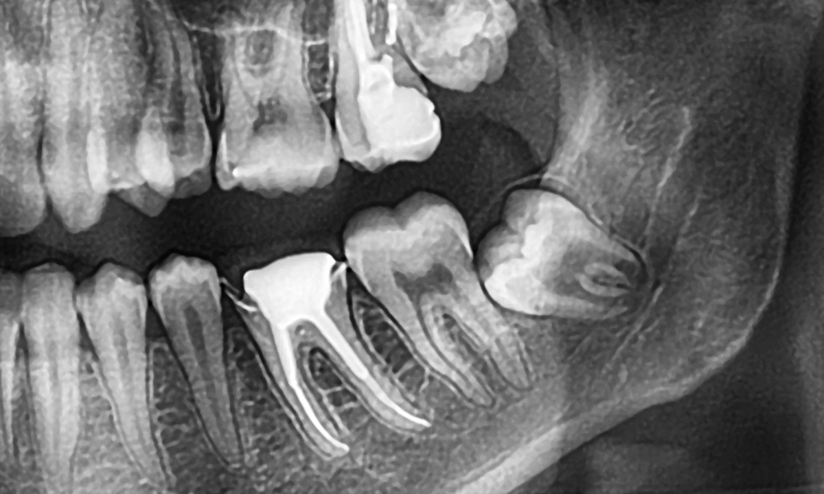 an x-ray of a person's teeth